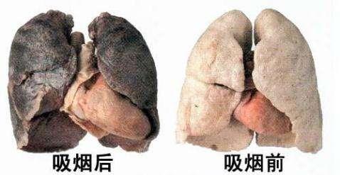 夫妻同患肺癌,癌会"传染"? 二手烟真的很可怕