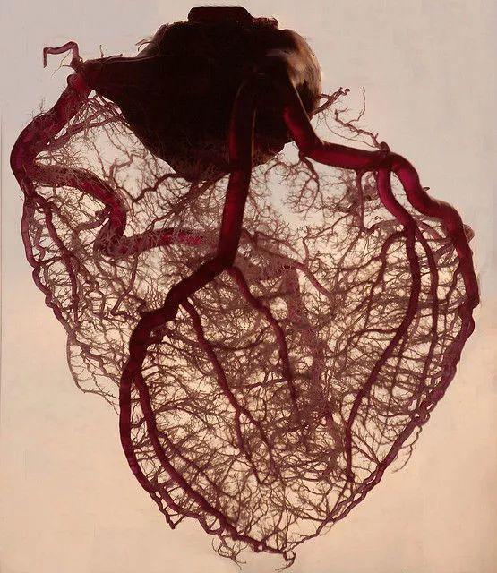 人体心脏三大主血管,小宋两根完全堵塞,一根严重狭窄.