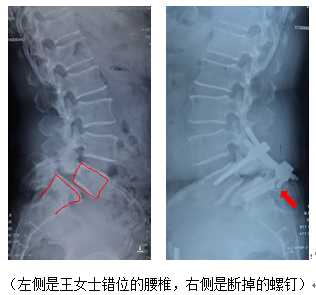 多次手术患者脊椎再错位 邵医专家"翻修"后挺直腰板
