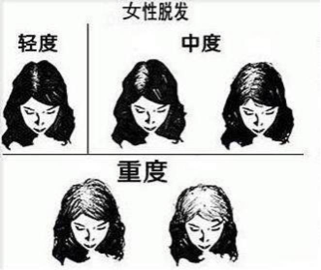 该种类型的脱发共分为7级,从1至7脱发程度逐级递增;而女性的脱发则按