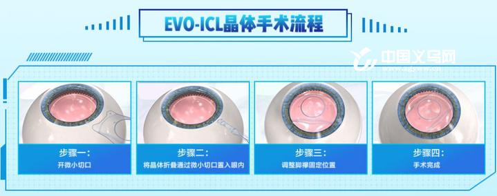 10分钟让千度近视患者拆掉眼镜义乌完成首例icl植入术
