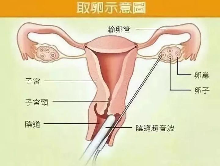 他们所使用的取卵工具是一根30多厘米长,有2毫米粗的空心针.