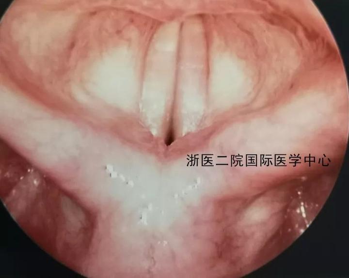 正常声带