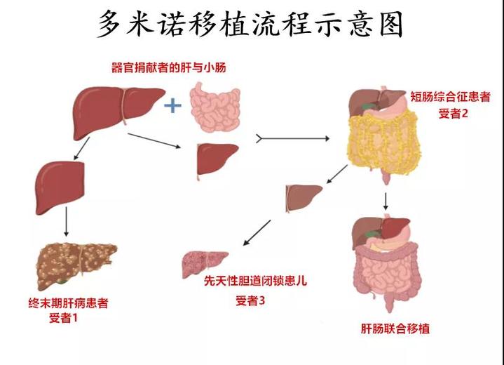 全球首例多米诺肝移植联合小肠移植手术 同一天挽救三个家庭