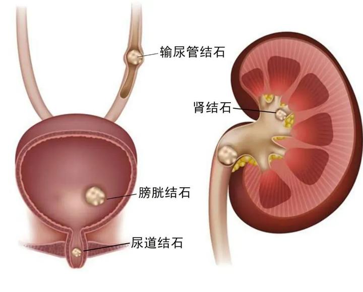 身体卡"石头" 男子三天不小便……取石后居然第二天就可以走回家