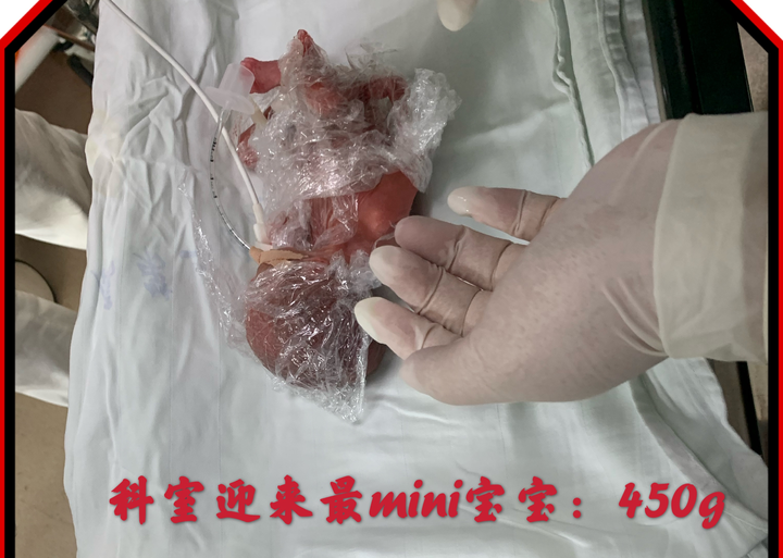 出生时仅450克,刷新我省新生男婴