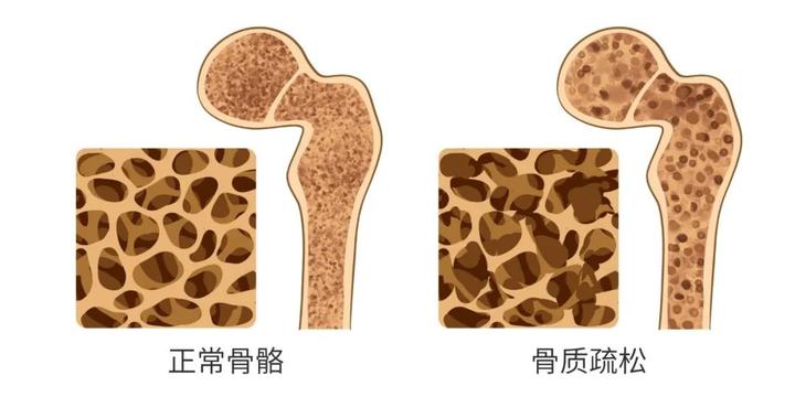 身体出现这些症状,快查查骨密度!