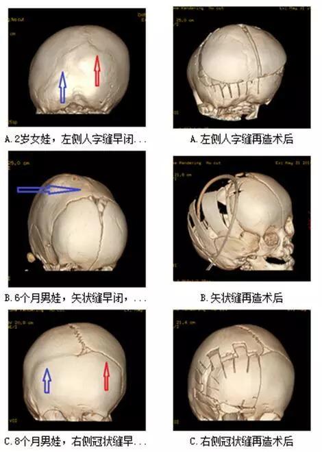 如果确实是颅缝早闭,早期手术的效果比较理想.